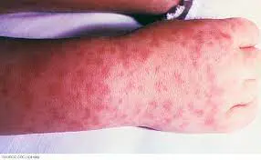 Rocky Mountain Spotted Fever Rash