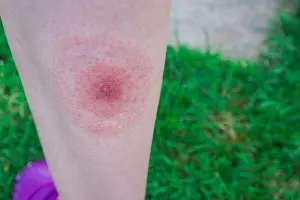 Lyme Bulseye